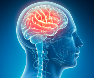 Brain Stroke